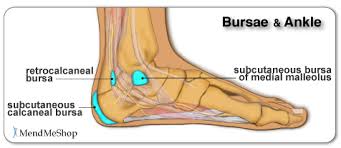 Calcaneous Bursitis – Sore Heel